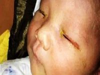 Fotoğraf makinasının flaşı bebeği kör etti