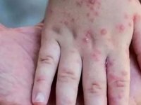 Tabipler, maymun çiçeği konusunda uyardı: Ülkeye girişlerde denetim