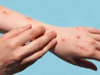 4 soruda maymun çiçeği salgını: En tehlikeli varyant