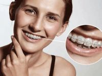 Diş teli ile ilgili 5 önemli bilgi!